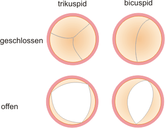 Bikuspide Aortenklappe Herzdoktor